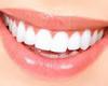 Teeth whitening in Marbella